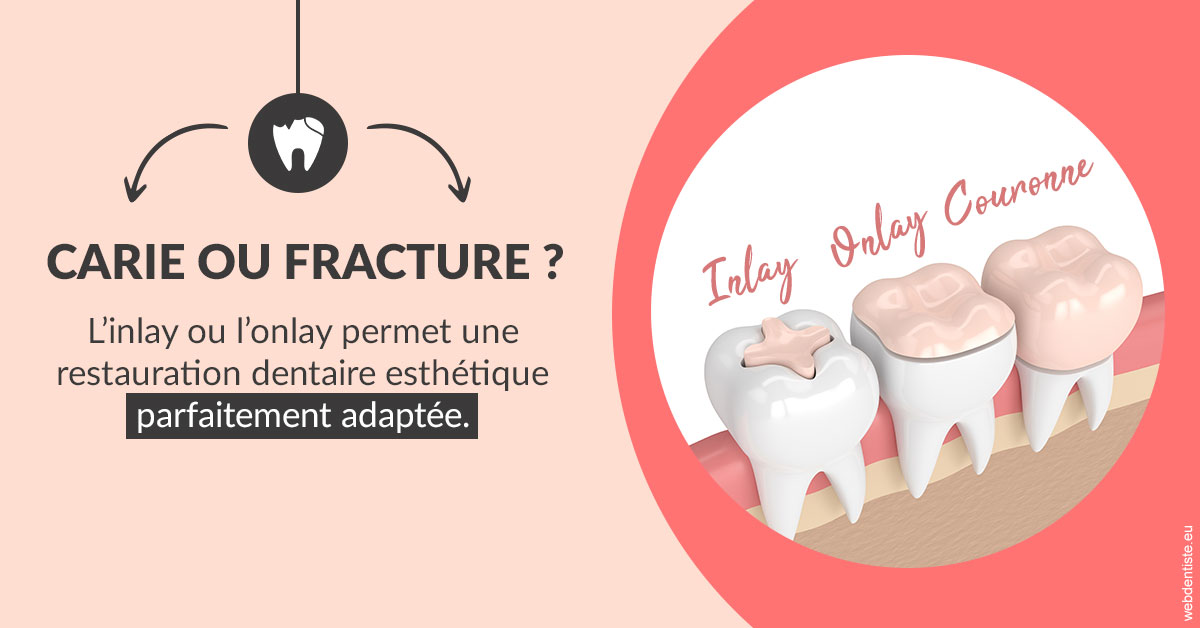 https://dr-buessinger-luc.chirurgiens-dentistes.fr/T2 2023 - Carie ou fracture 2