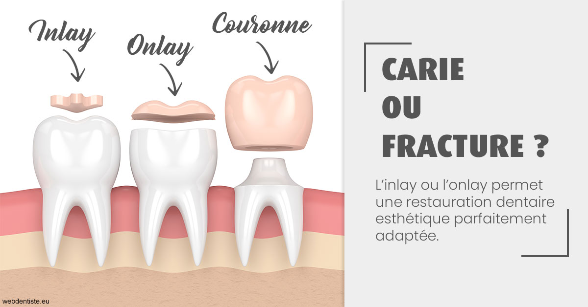 https://dr-buessinger-luc.chirurgiens-dentistes.fr/T2 2023 - Carie ou fracture 1