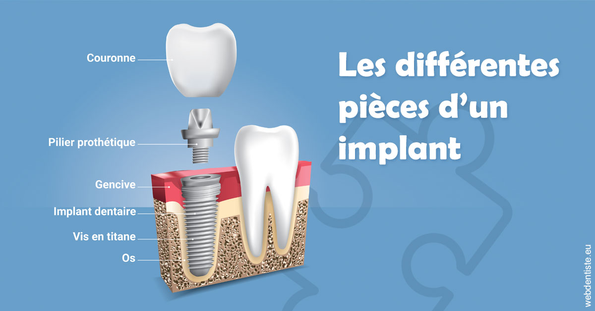 https://dr-buessinger-luc.chirurgiens-dentistes.fr/Les différentes pièces d’un implant 1