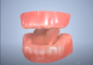 Prothèse dentaire complète amovible
