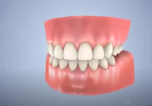 Prothèse dentaire partielle amovible